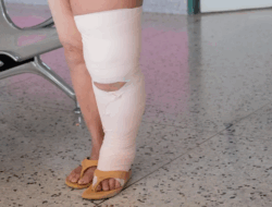Tiga Warga Simeulue Mengidap Penyakit Kaki Gajah
