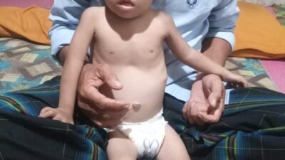 Balita 22 Bulan Asal Aceh Jalani Pengobatan Jantung di RS Harapan Kita